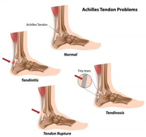 Ankle Problems